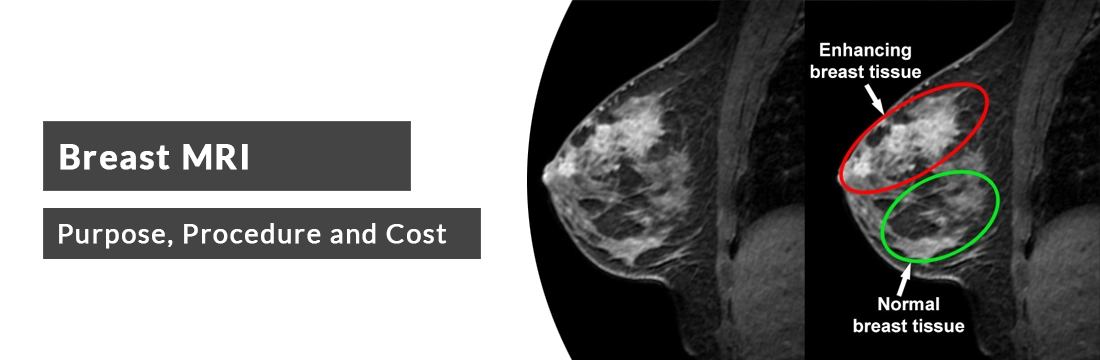 Breast MRI: Purpose, Procedure, Cost and Best MRI Centre